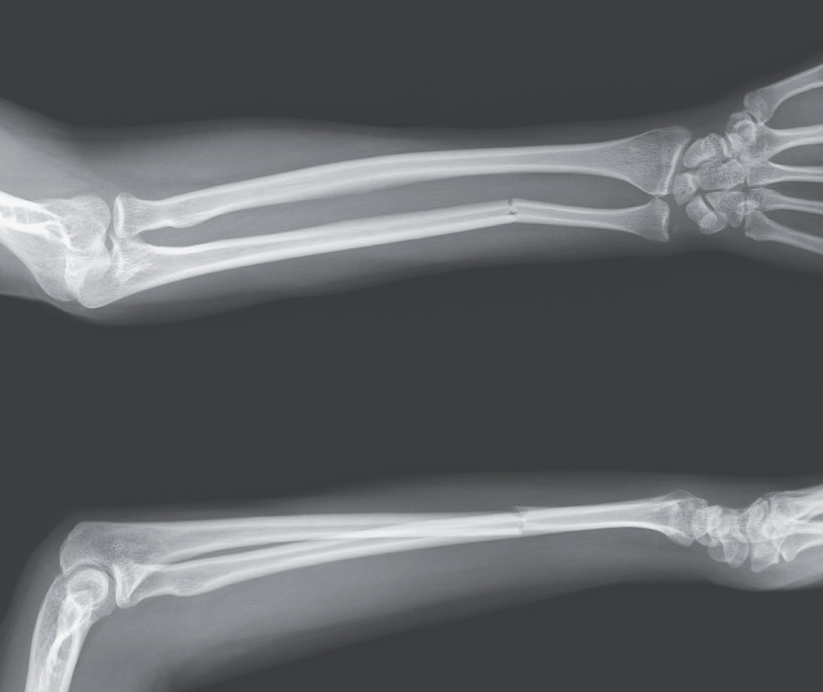 Isolated Ulnar Shaft Fracture Home